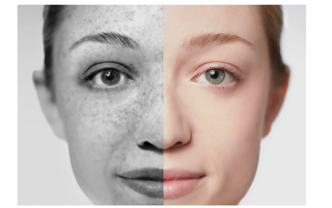 Dark Spots: Sun, Hormones… or Skin Stress?