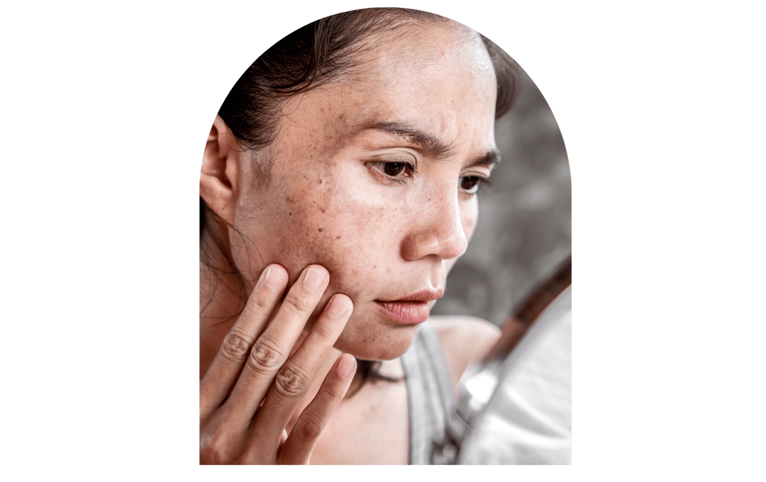 Dark spots: Here is how to treat them