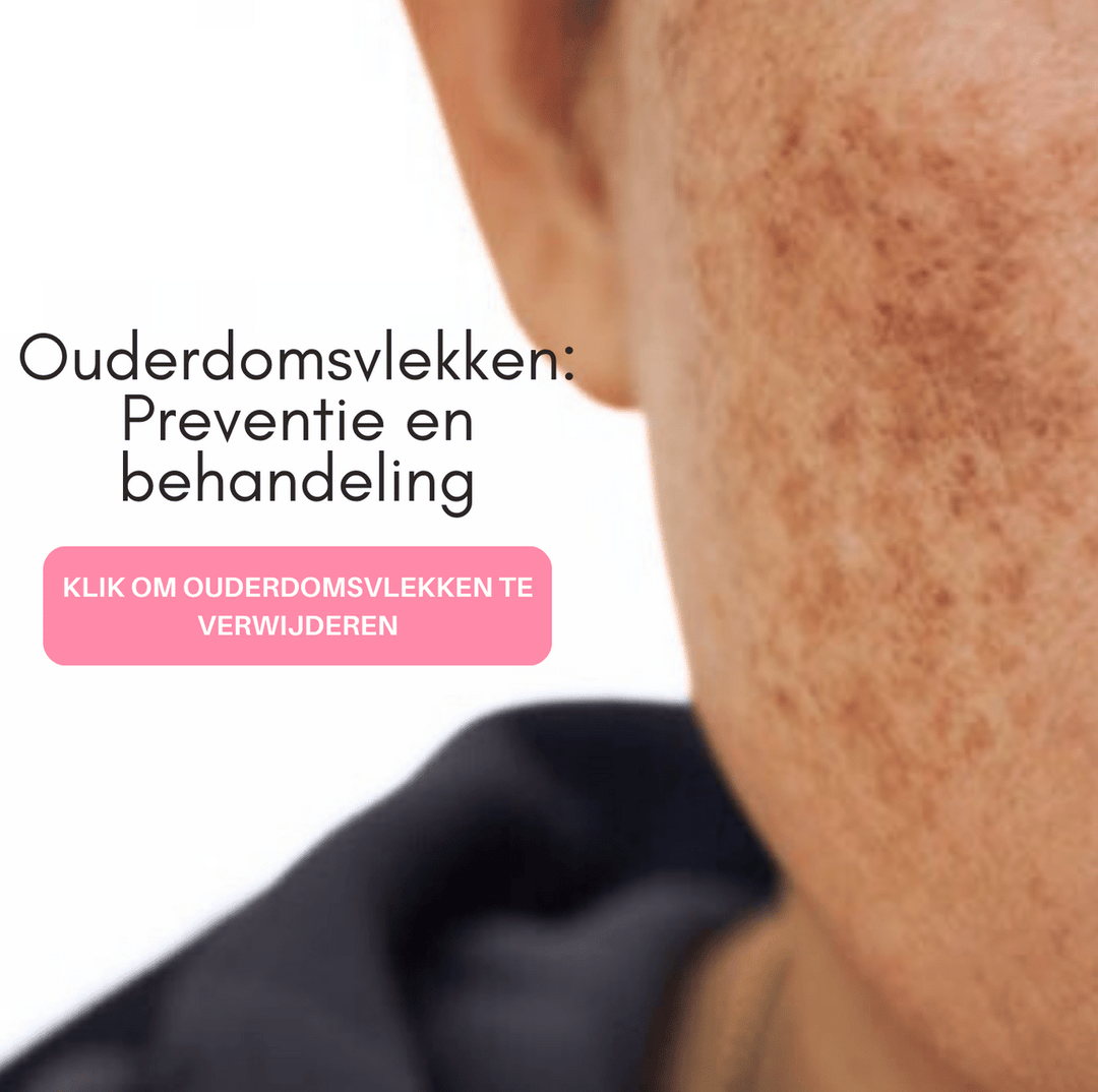 Ouderdomsvlekken: Preventie en behandeling